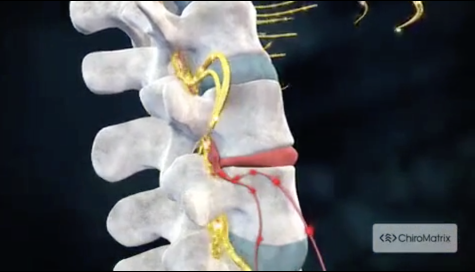 Can a Chiropractor Fix a Herniated Disc? - Oviedo Chiropractic